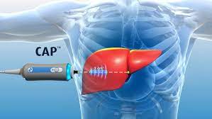 Liver Elastography (Fibroscan*)
